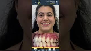 Client Tesitimonial | Dr Amit Sachdeva India's most experienced Invisalign Braces Specialist.