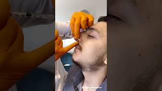 Non Surgical Nose Job By Dr. Rivkin