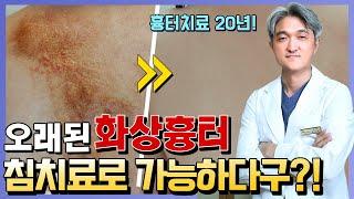 오래된 화상흉터까지 침치료로 가능하다구?! 가능합니다!｜피부재생치료, 튼살. 흉터치료, 여드름흉터 - 명옥헌 한의원
