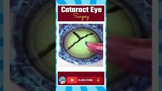 ️ Cataract Eye Surgery Explained in 30 Seconds!