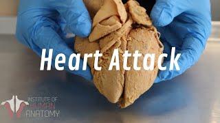 What Happens During a Heart Attack | Anatomy of a Heart Attack