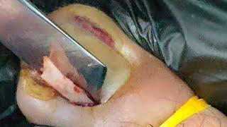 Shocking video of the most extreme ingrown toenail of 2024