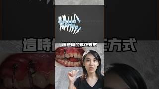 最難矯正的咬合，不開刀只戴牙套怎麼做#牙齒矯正#骨釘