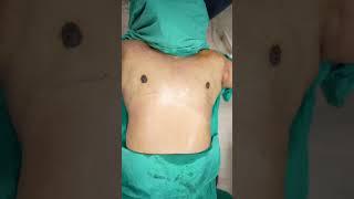 Gynecomastia Surgery #shortvideo #dezireclinicindia