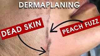 WATCH: FULL DERMAPLANING TREATMENT