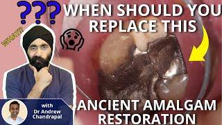 When Should I Replace This Ancient Amalgam Restoration - PDP083