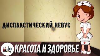 Диспластический невус