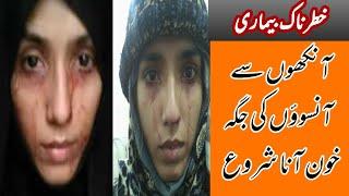 The Girl Who Cries Blood | Extraordinary People | Our Lives | Hadaf Tv