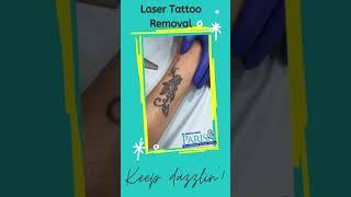 Laser Tattoo Removal — Dr Ashima Goel’s Parisa Skin Cosmetic & Laser Centre Chandigarh Mohali