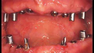 Full mouth rehabilitation with Dentium Guide on edentulous state ‘done in 1 hour'_Dr.Kang-Hee Lee