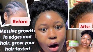 How to grow your edges faster| How to treat Aloepecia quickly| Hair loss #edgeentity #naturalhair