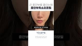 중안부 길이 축소에 특화된 리프팅이 있다고?