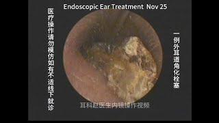 Management of a case of ear canal keratinization embolism 20241125