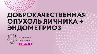 доброкачественная опухоль яичника + эндометриоз // Клиника Фомина.Обучаем