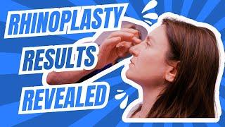 Rhinoplasty for Thick Skin | Westlake Plastic Surgery Transformation