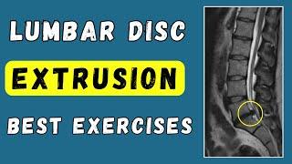 Best exercise and tips for lumbar disc extrusion recovery