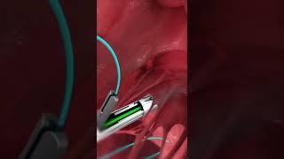 Mitral valve repair