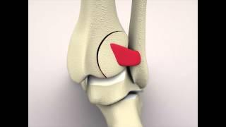 PER - Posterior Malleolar Fracture with Syndesmotic Rupture and Subsequent Diastasis