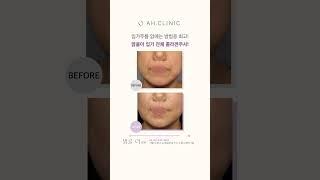입가 주름 없애는 방법 중 최고!맑을아 입가 전체 콜라겐 주사!  #콜라겐주사 #입가주름 #치마주름 ##고양이주름 #괄호주름 #아코디언주름 #상어주름 #입가노화 #베이비콜라겐