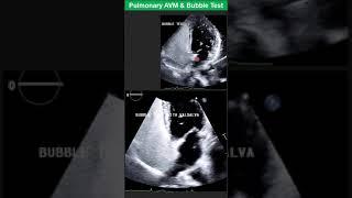 Pulmonary AVM & Bubble Test