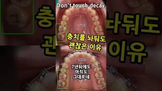 충치를 놔둬도 괜찮은 이유. 변색은 충치가 아니므로 놔둬도 됩니다. 속아서 파낼 필요없습니다. 21_2024_07_22