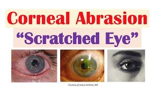 Corneal Abrasion (“Scratched Eye”) | Causes, Signs & Symptoms, Diagnosis, Treatment