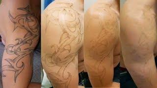 Eliminar tatuajes con láser Antes y después | Borratatu Barcelona