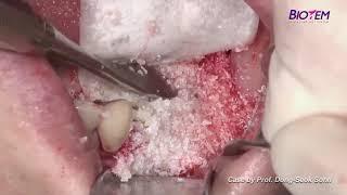 Simple 3 D ridge augmentation using tenting abutments (SANTA)