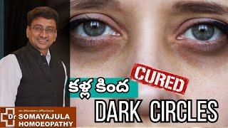 Can DARK CIRCLES be Cured ? Dr Suresh Somayajula