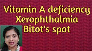 Xerophthalmia// Vitamin A deficiency// Bitot's spot