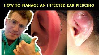 How to recognise, manage and treat an infected ear piercing | Doctor O'Donovan explains...