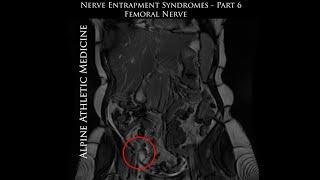 Femoral Nerve Entrapment: Image-Guided Minimally-Invasive Treatment of Peripheral Femoral Nerve