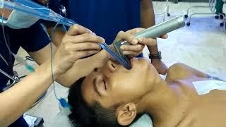 Double Lumen endotracheal tube insertion