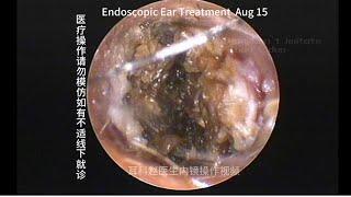 External auditory canal cholesteatoma misdiagnosed as cerumen embolism