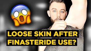 STRANGE Side Effects from Post-Finasteride Syndrome Sufferer... LOOSE SKIN?! | Mark's PFS Experience