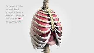 Longitudinal Sternal Stabilization (LSS)