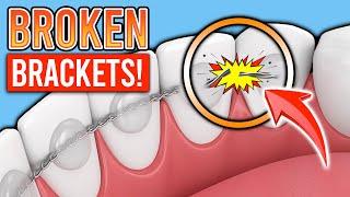 BRACES 101: Cracked Retainer After Braces or Invisalign: WHAT NOW?! | Treatment Minute Talk!