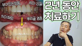 2년에 걸쳐 완성한 11개의 임플란트!! 그리고 신경치료와 발치까지..!