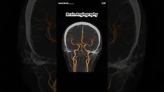 Brain Angiography #radiography #xray #hospital
