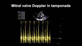 Echocardiography Essentials: Detecting pericardial effusions