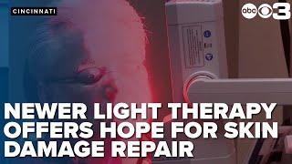 Newer light therapy offers hope for skin damage repair