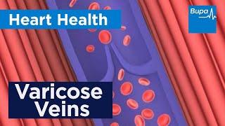 How varicose veins form | Bupa Health