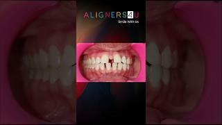 TEETH STRAIGHTENING WITH ALIGNERS4U #shorts #aligners #teeth #dental #invisalign #hyderabad #smile