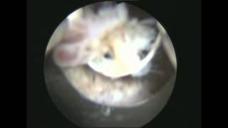 Transurethral resection of the bladder tumor - Plasma TURBT. Dr. Farid Gadimaliyev, Baku, Azerbaijan