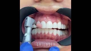 Creating shiny smiles - Bonding veneers (composite veneers)