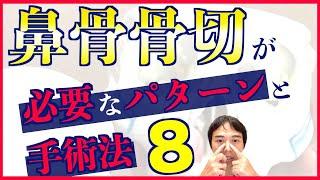 鼻骨骨切を骨ノミだけでやってるのはヤバい？確認すべき適応と手術の方法8選