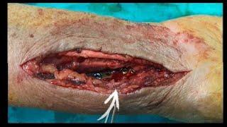 Radial Pulse Intraoperative Appearance with  Sound