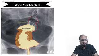 SPOTTERZ - 02 - Classic luminal narrowing of the Colon / Rectum