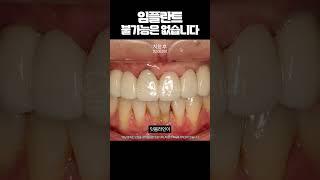 당뇨? 잇몸병? 이런 이유로 임플란트 포기하지 마세요.