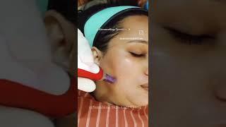 Microneedling Treatment/#youtube #skincarecenter #skincareclinic #yt #vitaminc #trending #face